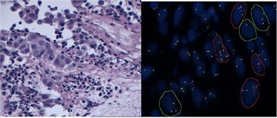 Molecular Testing on Cytology for Gene Fusion Detection